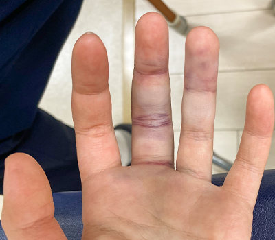突き指の写真